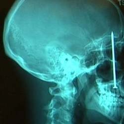 Sinar X Tingkatkan Risiko Kanker